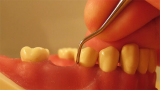 Обработки лунки удаленного зуба