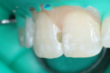 Дополнительная кариозная полость в зубе (помимо основной)